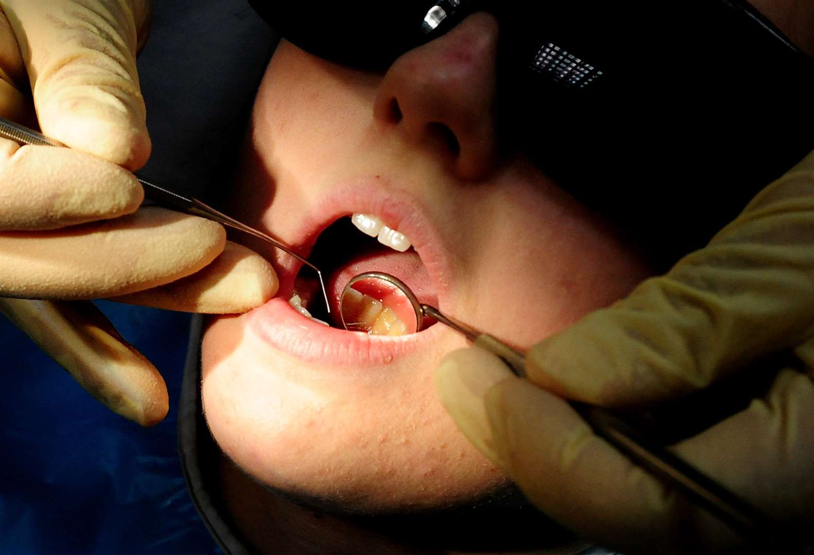 When it comes to oral health, prevention is better than cure (Rui Vieira/PA)