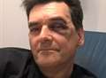 Teacher's broken cheek bones after vicious robbery