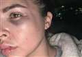 Mum left with broken cheekbone after nightclub attack