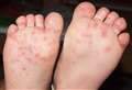 Hand, foot and mouth disease hits schools and nurseries