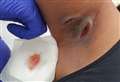 Teen left with gaping armpit wound for two years