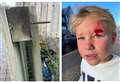 Boy, 5, 'almost blinded' by exposed screw