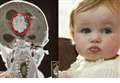 Golf ball sized tumour removed from baby's brain through pioneering surgery