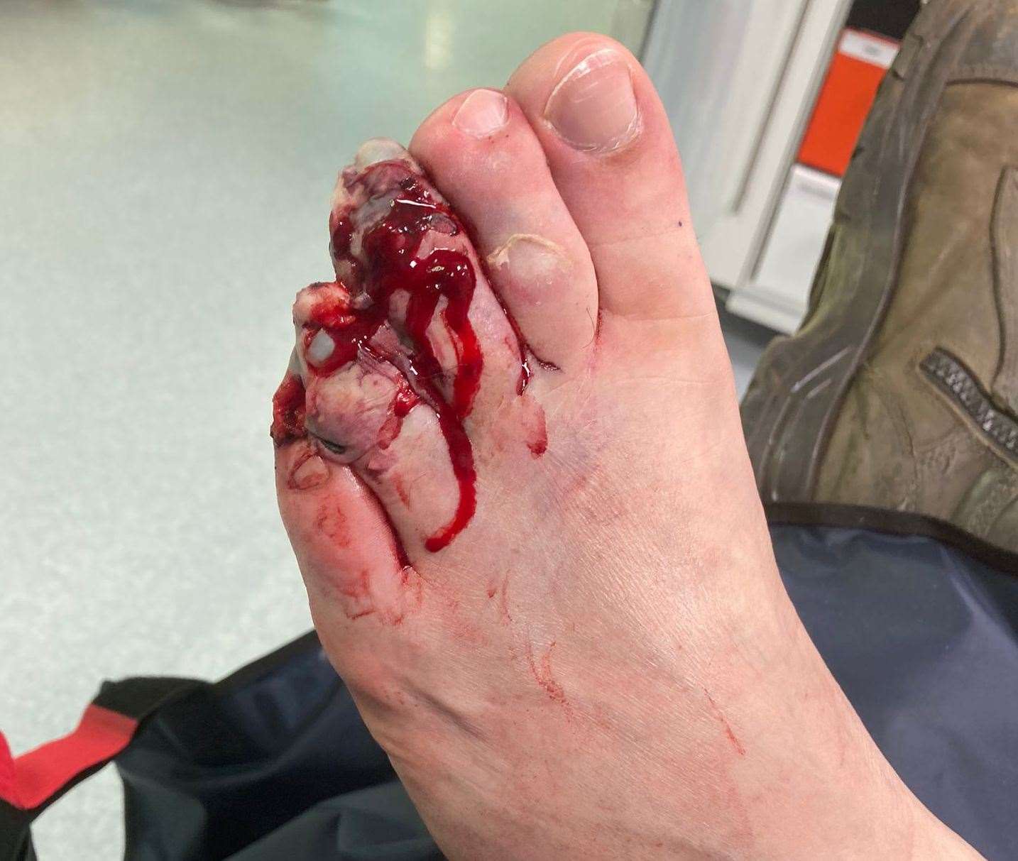 Colin Dell had his third toe amputated at the knuckle, his fourth completely amputated, and some bone "nibbled back” to repair his little toe