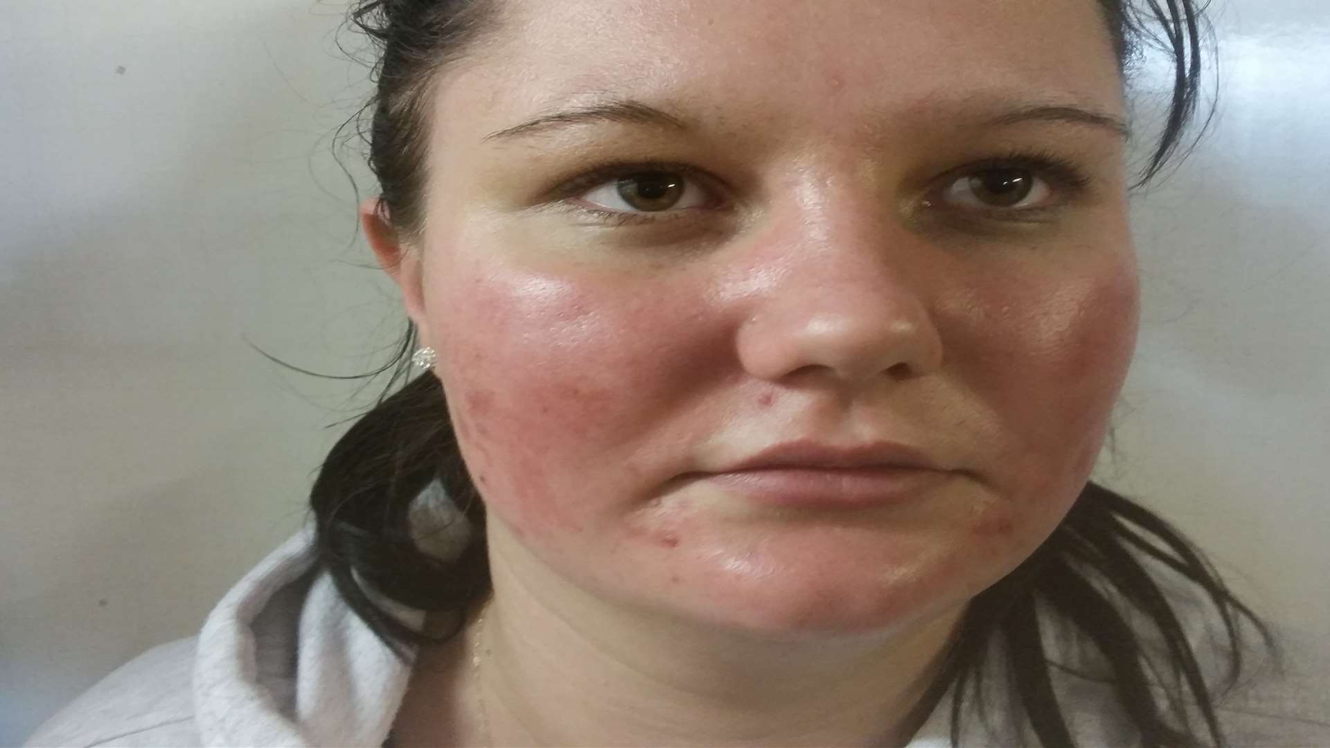 Chantelle Currell's face burnt and blistered after using a well known face mask