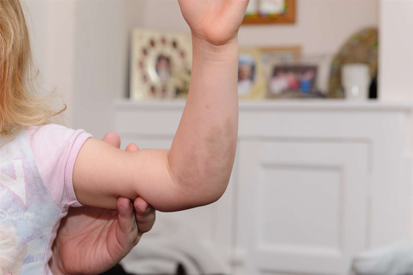 Ava-Rose suffered bruising to her arm