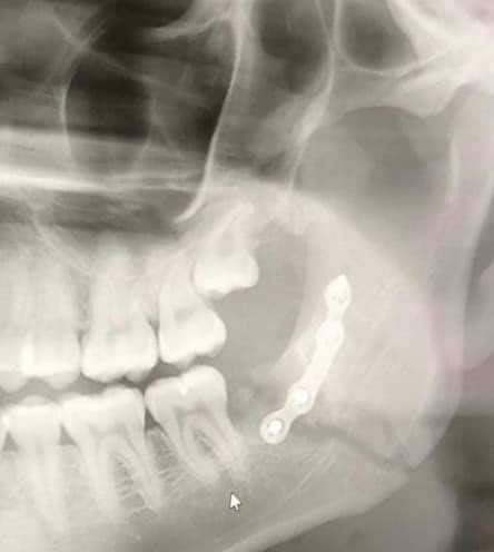 Sam Mason needed a metal plate in his jaw after an unprovoked attack. (12771493)