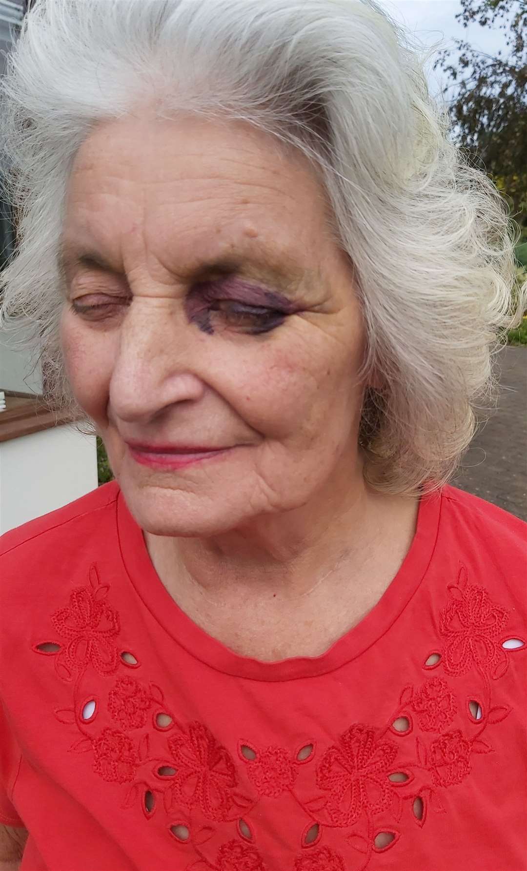 The bruise on Joan Stone's face, where was she struck with a gun