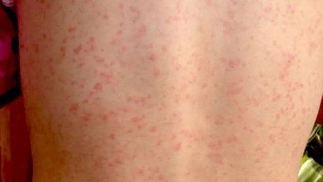 Scarlet fever is a contagious infection mostly affecting young children