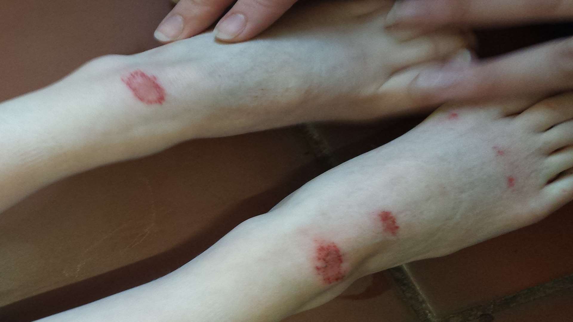 The grazes on Brendan Gifford's feet