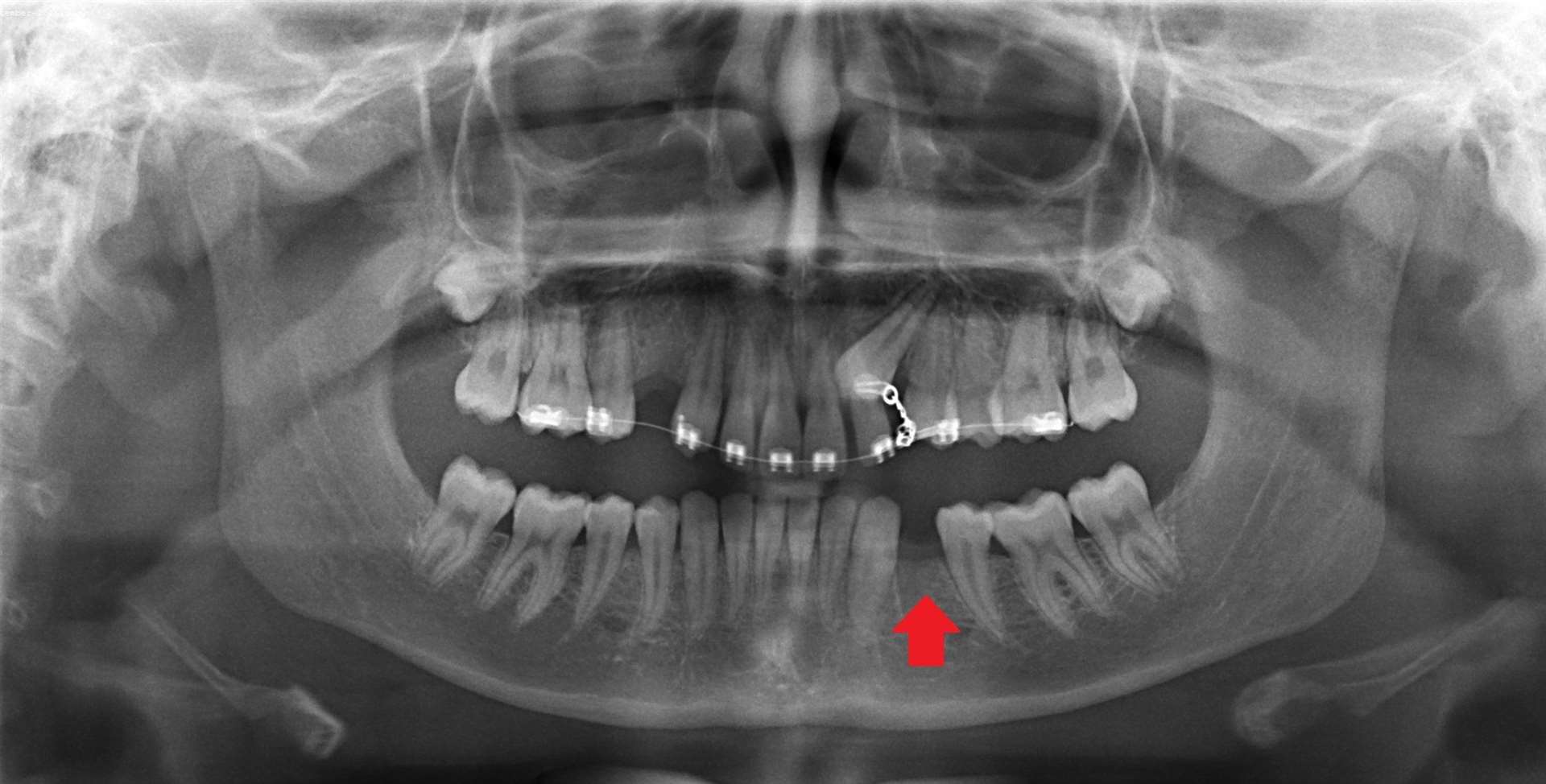 Courtney Monksfield's panoramic x-ray showing the location of the wrong tooth extraction. Picture: SWNS