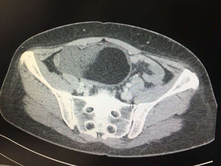 This shows the cyst in black stretching across the pelvis and pressing into organ tissue