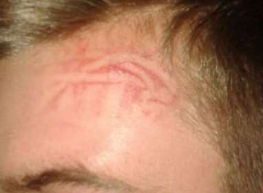 The victim had a footprint left on his head