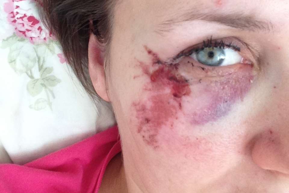 Jennie Ivinson was badly cut after a rock attack