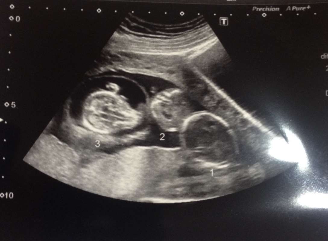 Jolene's scan