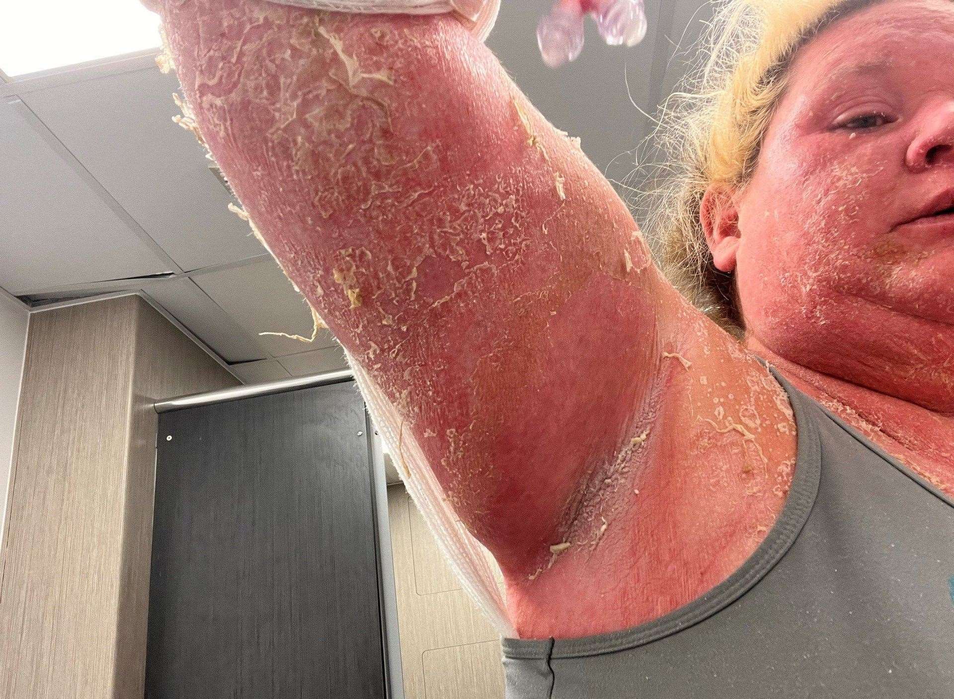 Amy's skin peeled off and her hair and nails fell off when she was bitten by a tiger mosquito in the Caribbean. Picture: SWNS