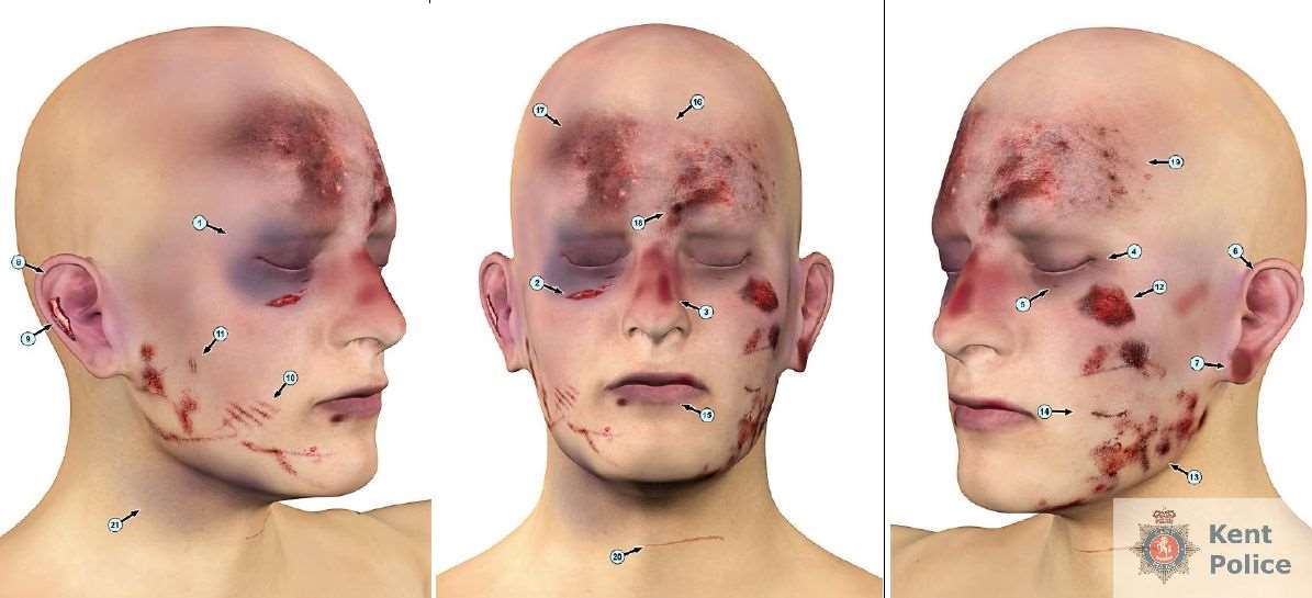 The extent of the injuries caused to Roy Blackman