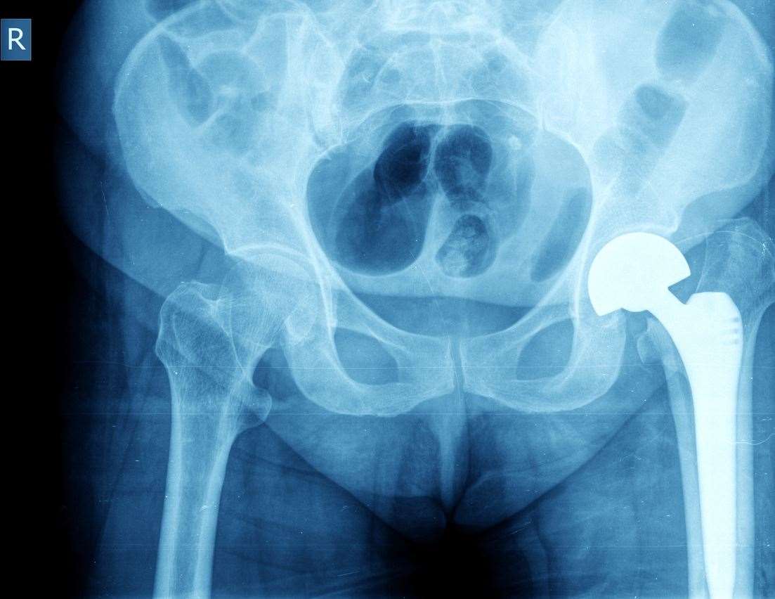 X-ray of the hip prosthesis