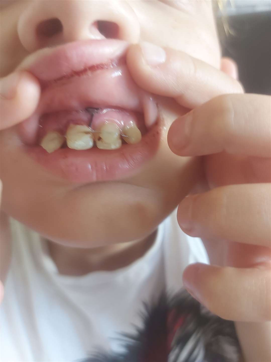 Denis-Cristian Bulancea, 12, with his tooth back in place after having it ripped out on a children's castle slide at Beachfields, Sheerness. Picture: Dumitru-Daniel Bulancea