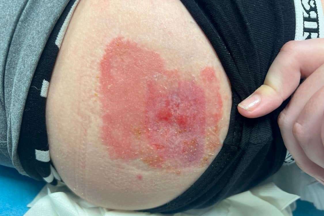 Chloe Norris' skin graft. Picture: Stacey Norris