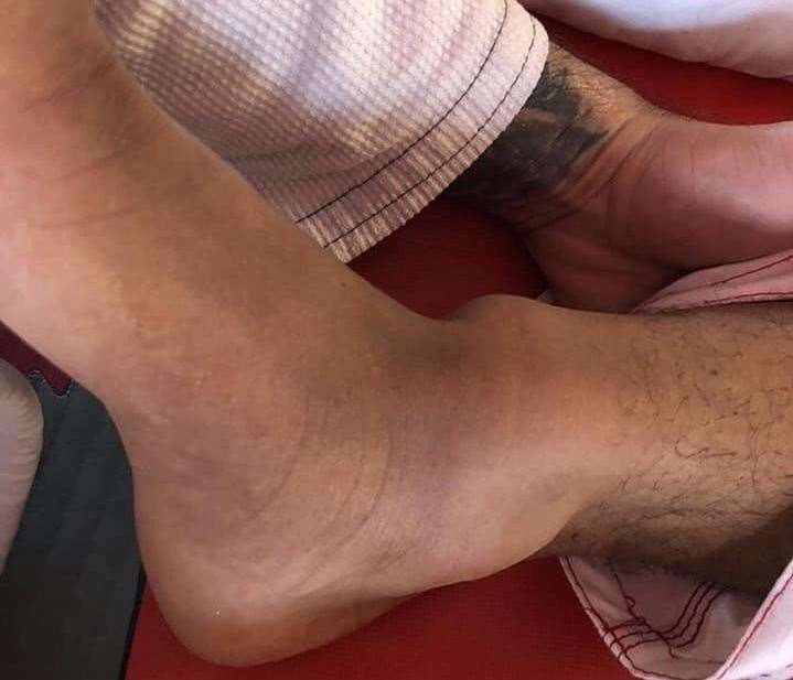 Kayne Isaac's badly broken ankle (19891081)