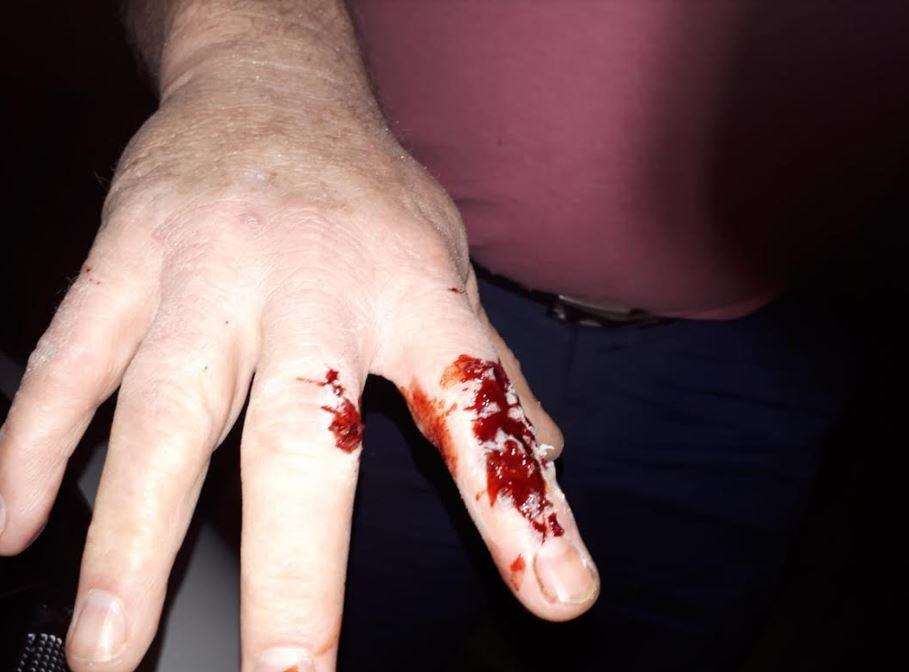 Jon Barrett's cut finger following the horrific incident (7616014)